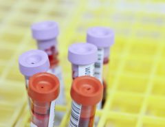 Аналіз на ВІЛ: як перевірити свій статус?